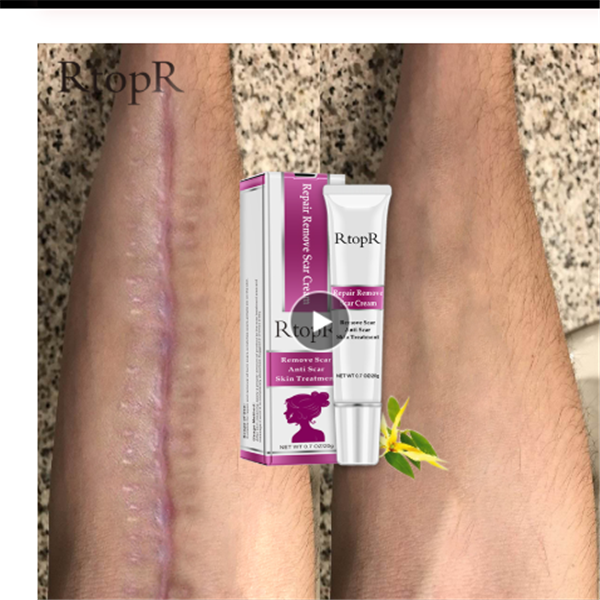 Acne Scar Removal Cream for Skin Repair and Healing